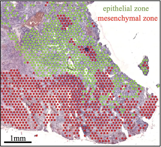 Spatial transcriptomic analysis of the ependymoma tumor microenvironment