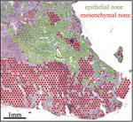 Spatial transcriptomic analysis of the ependymoma tumor microenvironment